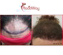 Slider image (3) MAXIM Hair Restoration Philippines